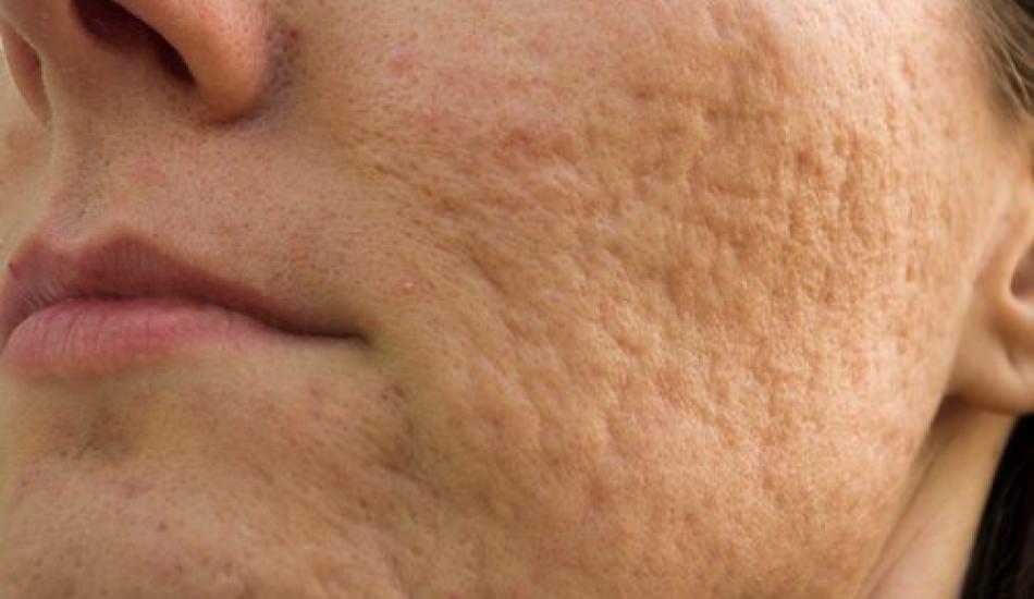 Yüzdeki sivilce izleri nasıl masraf? Sivilce izlerini gideren maske tanımları