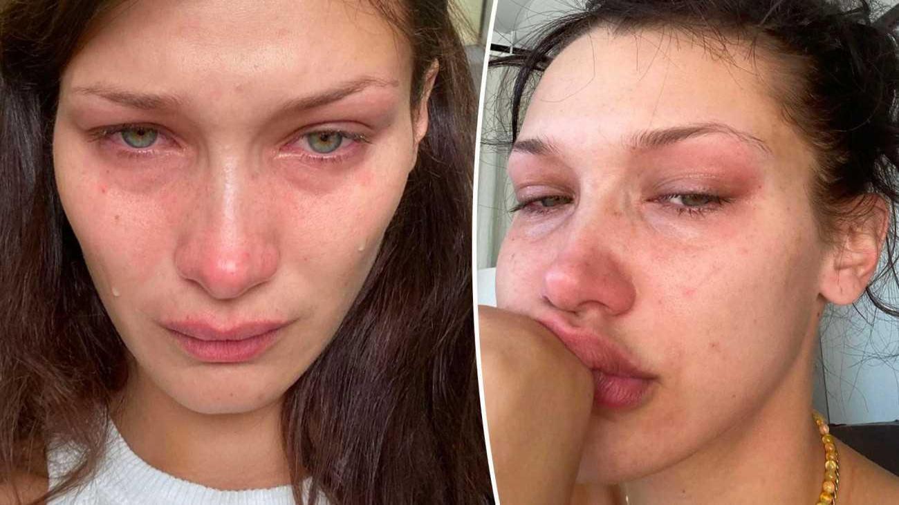 Bella Hadid’in hastalığı yüzünden bedeni morardı!