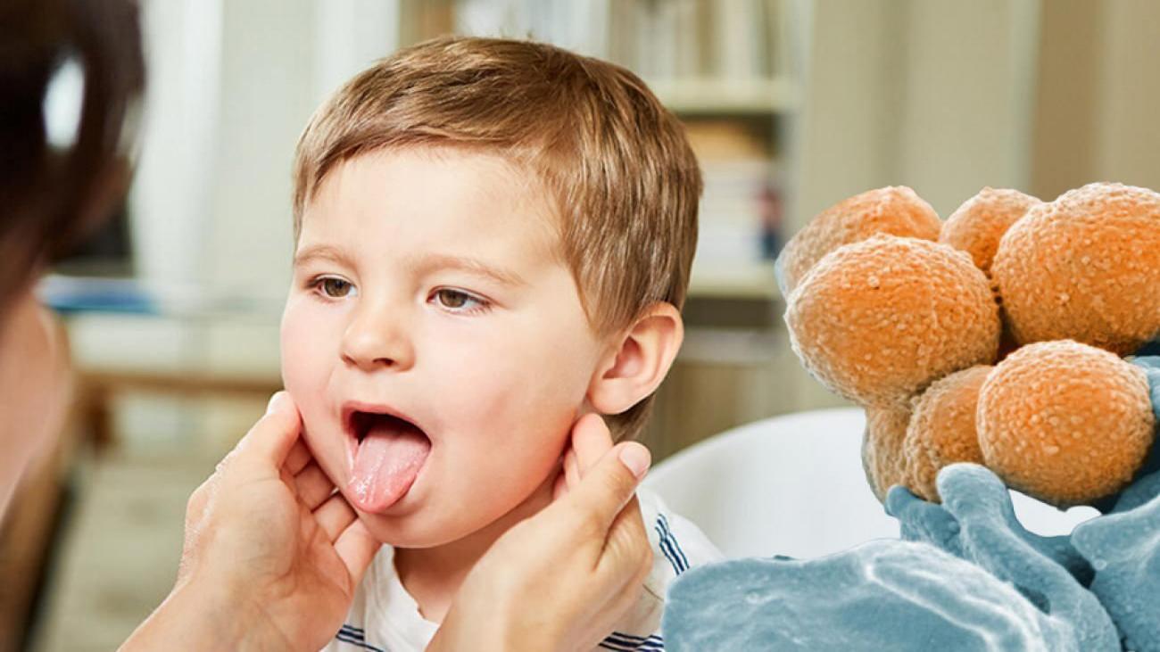 Strep A nedir? Strep A belirtileri nelerdir? Uzmanlardan ikaz geldi: Can almaya devam ediyor!